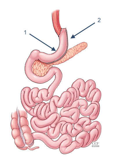 Bariatric Surgery Must Haves