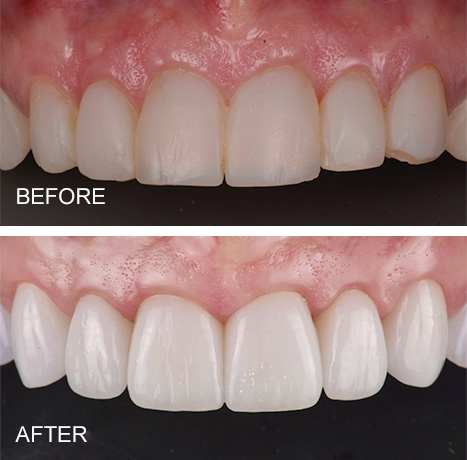 same day dental implants pros and cons