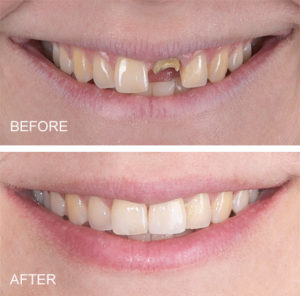 same day all on 4 dental implants near me