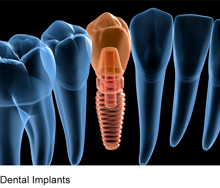 affordable same day dental implants