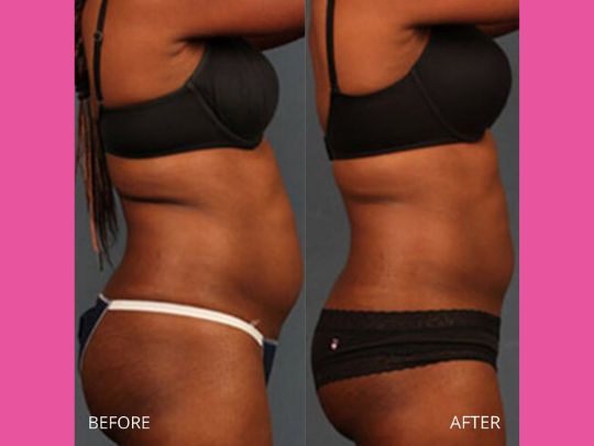 emsculpt neo Tewksbury MA 01876
