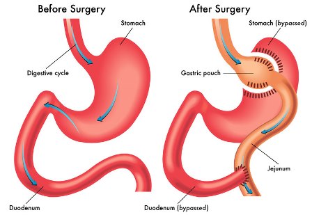 Bariatric Eat